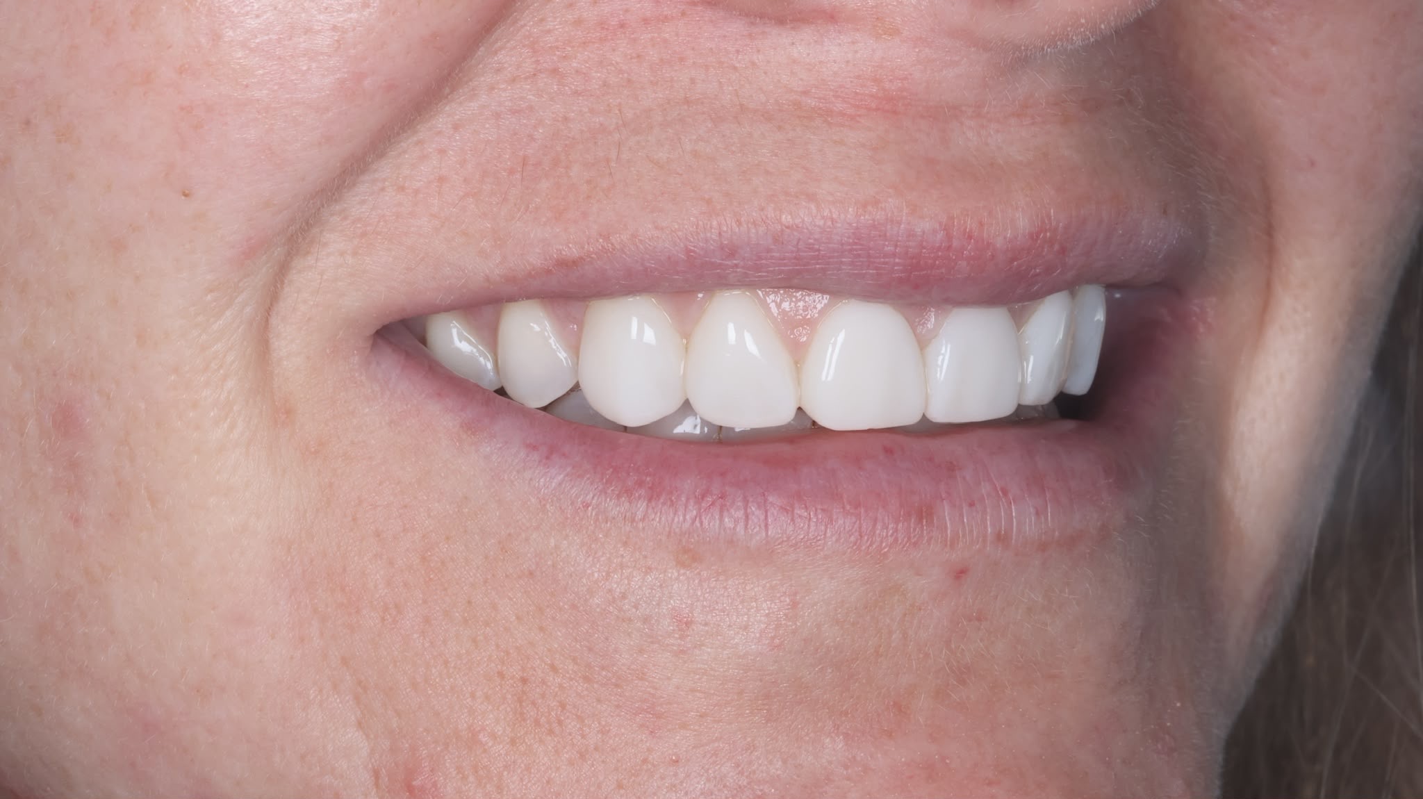 Dental treatment before-and-after comparison 4